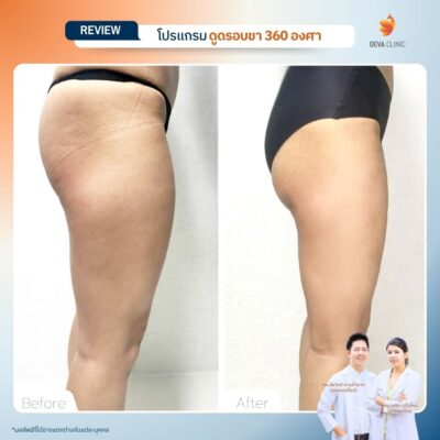 รีวิวก่อนหลัง ดูดไขมันร่องก้น 11