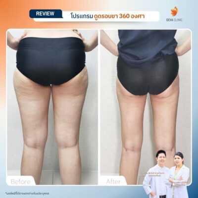 รีวิวก่อนหลัง ดูดไขมันร่องก้น 13