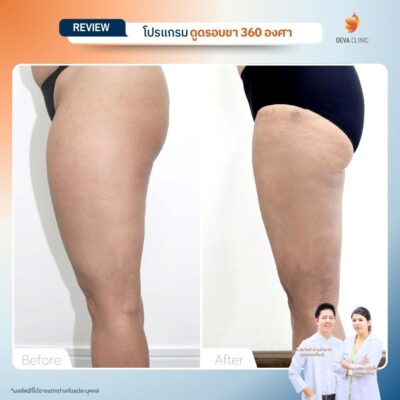 รีวิวก่อนหลัง ดูดไขมันร่องก้น 18