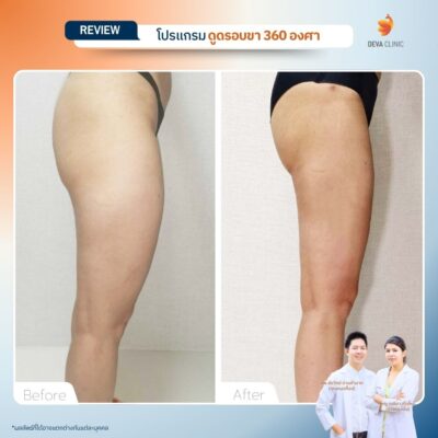 รีวิวก่อนหลัง ดูดไขมันร่องก้น 6