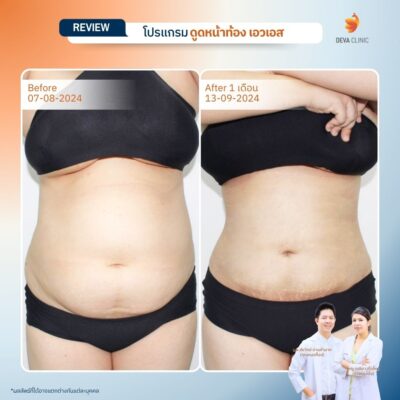 รีวิวดูดไขมันหน้าท้อง รวมรีวิว 3