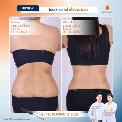 รีวิว ดูดไขมันเอว 13