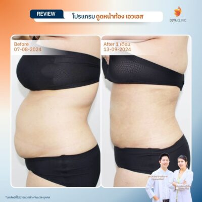 รีวิวดูดไขมันหน้าท้อง รวมรีวิว 19