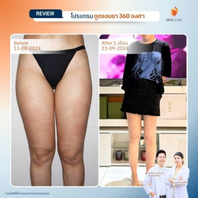 รีวิวดูดไขมันขา ที่ไหนดี 12