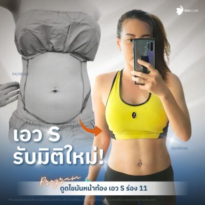 ผลลัพธ์ Before & After จากเคสจริง ดูดไขมันห่วงยาง เอวเอส 2