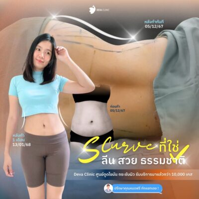 ผลลัพธ์ Before & After จากเคสจริง ดูดไขมันห่วงยาง เอวเอส 1