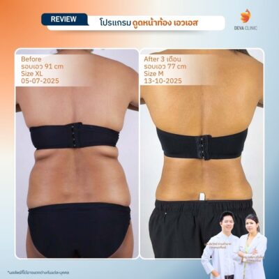 รีวิวดูดไขมันปีกข้าง ก่อนหลัง 6