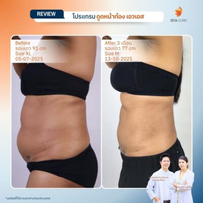 รีวิวผลลัพธ์ ก่อน-หลังจากเคสจริง ดูดไขมัน หน้าท้องล่างป่อง 6