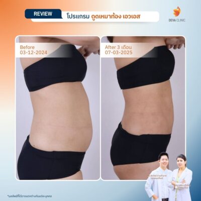 รีวิวผลลัพธ์ ก่อน-หลังจากเคสจริง ดูดไขมัน หน้าท้องล่างป่อง 4