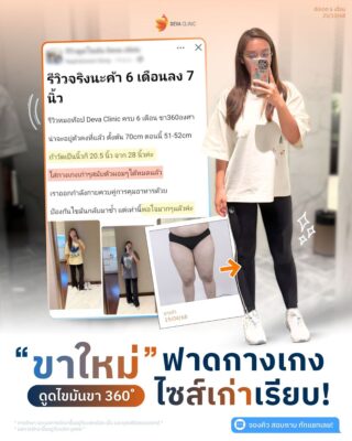 รีวิวแชทดูดไขมันต้นขา คุณชารีฟ