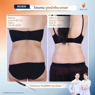 รีวิวดูดไขมันปีกข้าง ก่อนหลัง 9