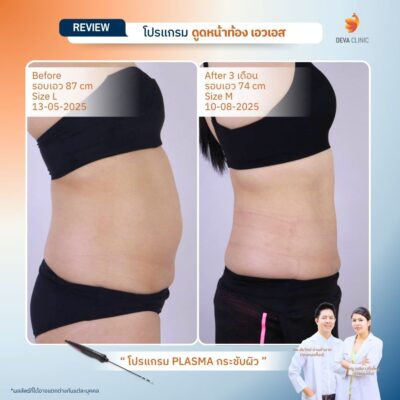 รีวิวดูดไขมันหน้าท้อง รวมรีวิว 15