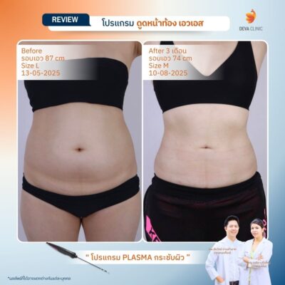 รีวิว ดูดไขมันเอว 12