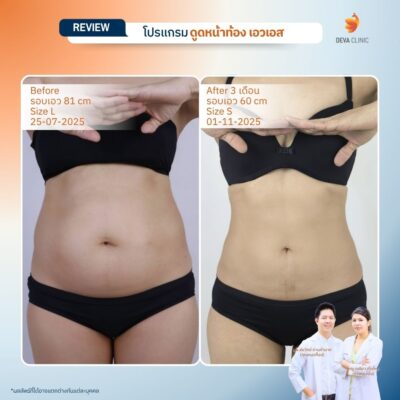 รีวิวดูดไขมันเอว S 8