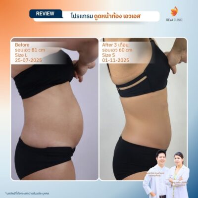 รีวิวผลลัพธ์ ก่อน-หลังจากเคสจริง ดูดไขมัน หน้าท้องล่างป่อง 10
