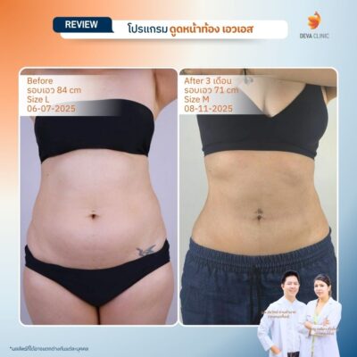 รีวิวดูดไขมันเอว S 7