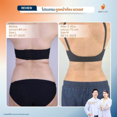 รีวิวดูดไขมันปีกข้าง ก่อนหลัง 10