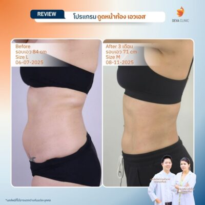 รีวิวผลลัพธ์ ก่อน-หลังจากเคสจริง ดูดไขมัน หน้าท้องล่างป่อง 11