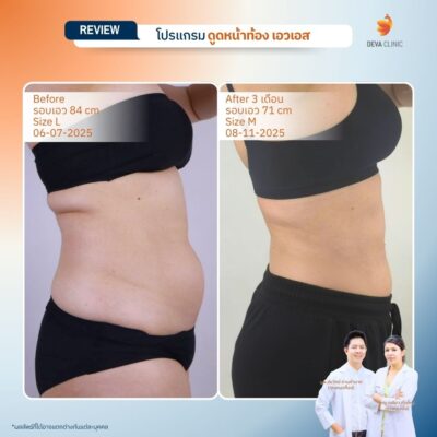รีวิวผลลัพธ์ ก่อน-หลังจากเคสจริง ดูดไขมัน หน้าท้องล่างป่อง 12