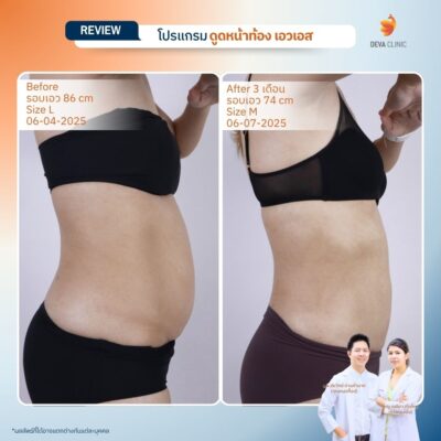 รีวิวก่อนหลังทำ คุณกล้วยไม้ 3