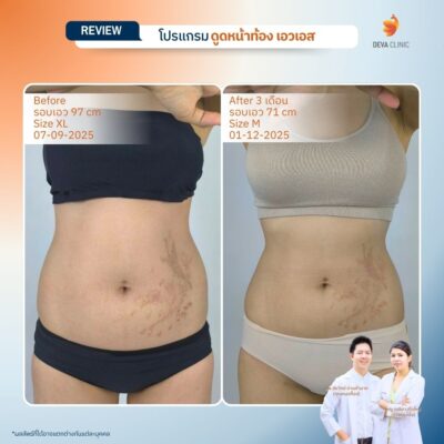 รีวิวดูดไขมันเอว S 6