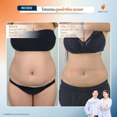 รีวิวก่อนหลังดูดไขมันลดพุง 16