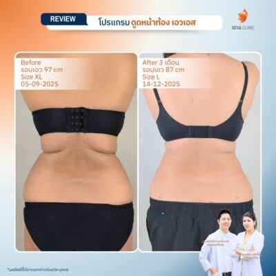 รีวิวดูดไขมันปีกข้าง ก่อนหลัง 11