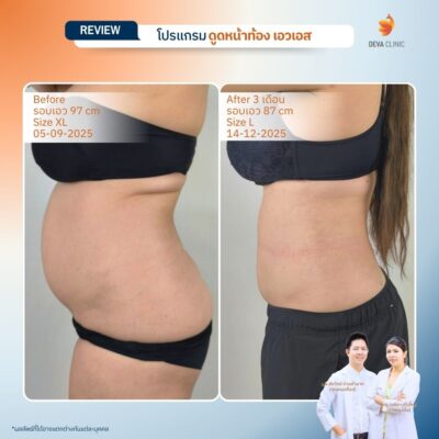 รีวิวดูดไขมันหน้าท้อง รวมรีวิว 17