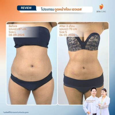 รีวิวดูดไขมันเอว S 4