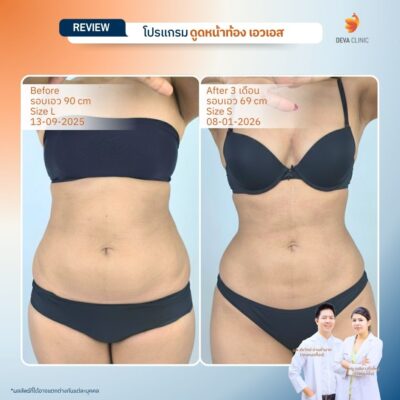 รีวิวก่อนหลังดูดไขมันลดพุง 13
