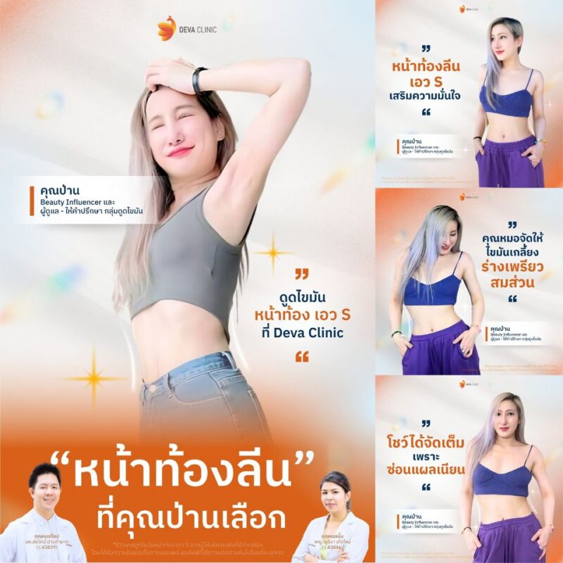 ผลลัพธ์หลังดูดไขมันหน้าท้อง คุณป่าน