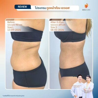 รีวิวก่อนหลังดูดไขมันลดพุง 15