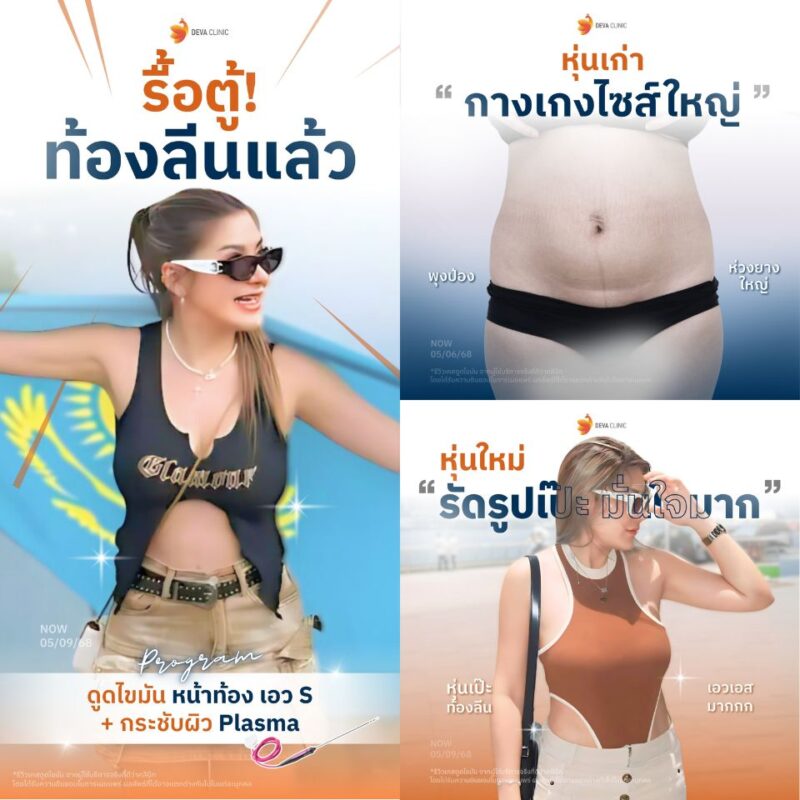 ผลลัพธ์หลังดูดไขมันหน้าท้อง คุณ
