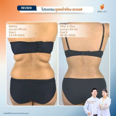 รีวิวดูดไขมันเอว S 3