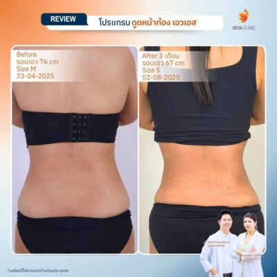 รีวิว ดูดไขมันเอว 18
