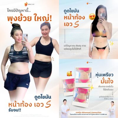 รีวิวผลลัพธ์ ก่อน-หลังจากเคสจริง หน้าท้องล่างป่อง 1