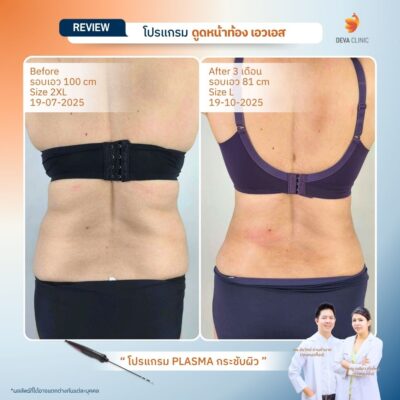 รีวิวดูดไขมันปีกข้าง ก่อนหลัง 12