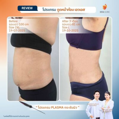รีวิวผลลัพธ์ ก่อน-หลังจากเคสจริง ดูดไขมัน หน้าท้องล่างป่อง 13
