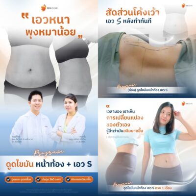 รีวิวผลลัพธ์ ก่อน-หลังจากเคสจริง หน้าท้องล่างป่อง 2