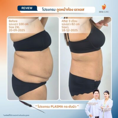 รีวิวผลลัพธ์ ก่อน-หลังจากเคสจริง ดูดไขมัน หน้าท้องล่างป่อง 14