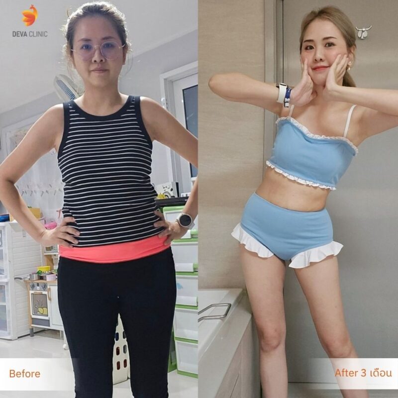 แนวทางการรักษา หลังดูดหน้าท้อง คุณกล้วยไม้