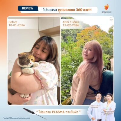 รีวิวก่อนหลังดูดไขมัน คุณพลอย