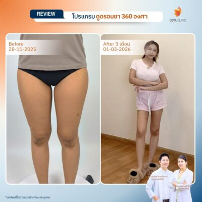 รีวิวดูดไขมันขา ที่ไหนดี 15