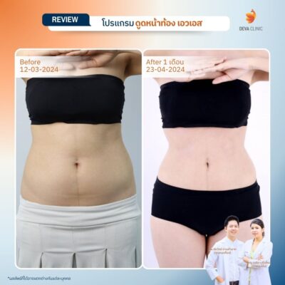รีวิวดูดไขมันหน้าท้อง รวมรีวิว 8
