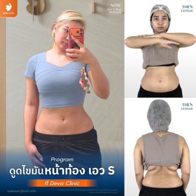 รีวิวดูดไขมันเอว S คุณซัมเมอร์
