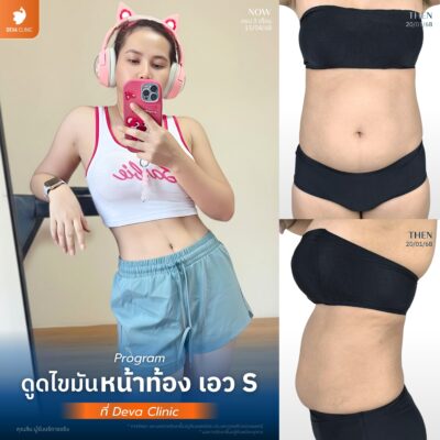 รีวิวดูดไขมันเอว S คุณปูเป้