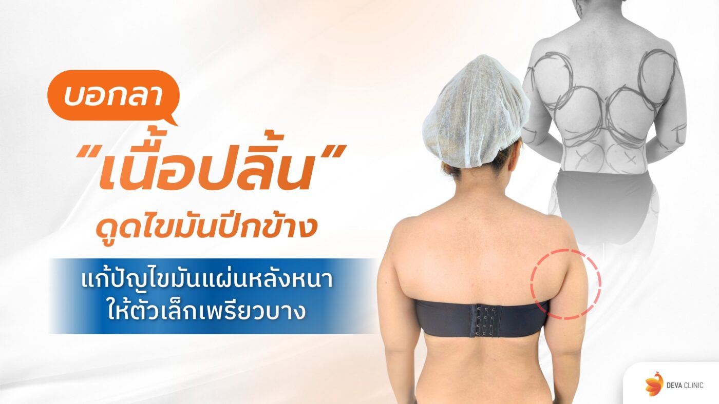 ดูดไขมันปีกข้าง