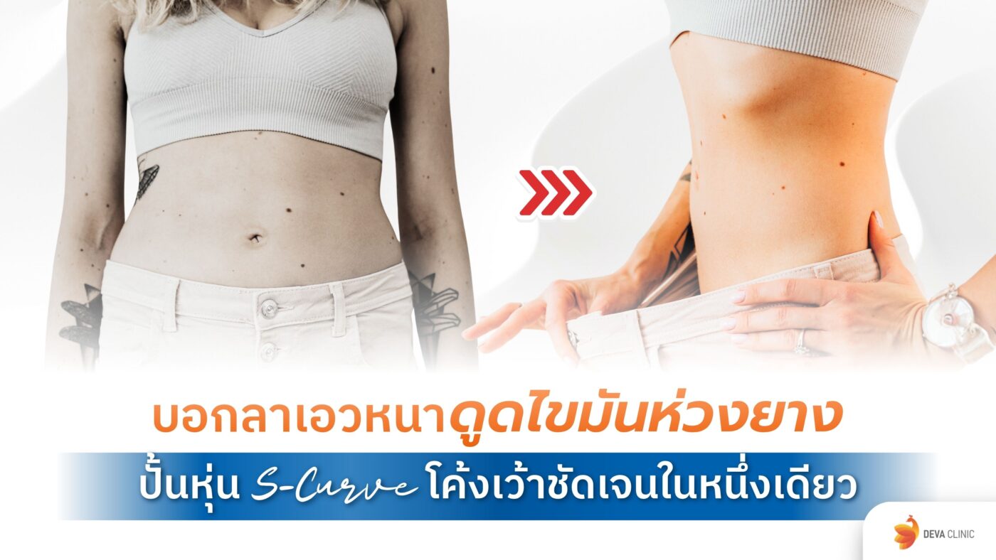 ดูดไขมันห่วงยาง