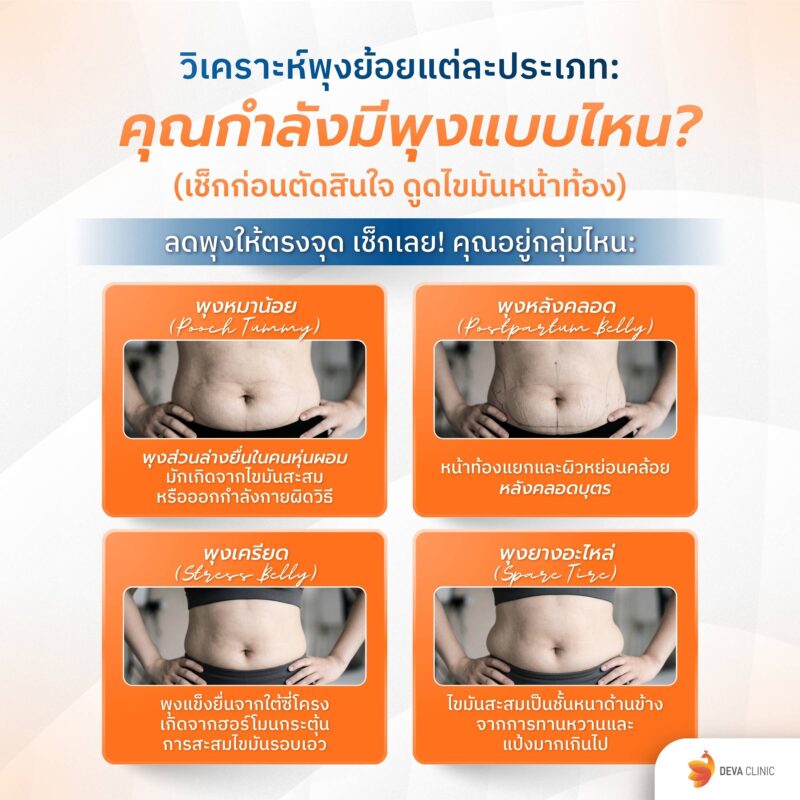 วิเคราะห์พุงย้อยแต่ละประเภท: คุณกำลังมีพุงแบบไหน? (เช็กก่อนตัดสินใจ ดูดไขมันหน้าท้อง)