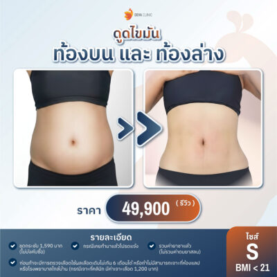ราคาดูดไขมันหน้าท้อง ปี 2026 S